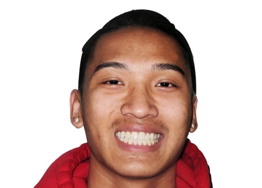 Patient smile after orthodontic treatment