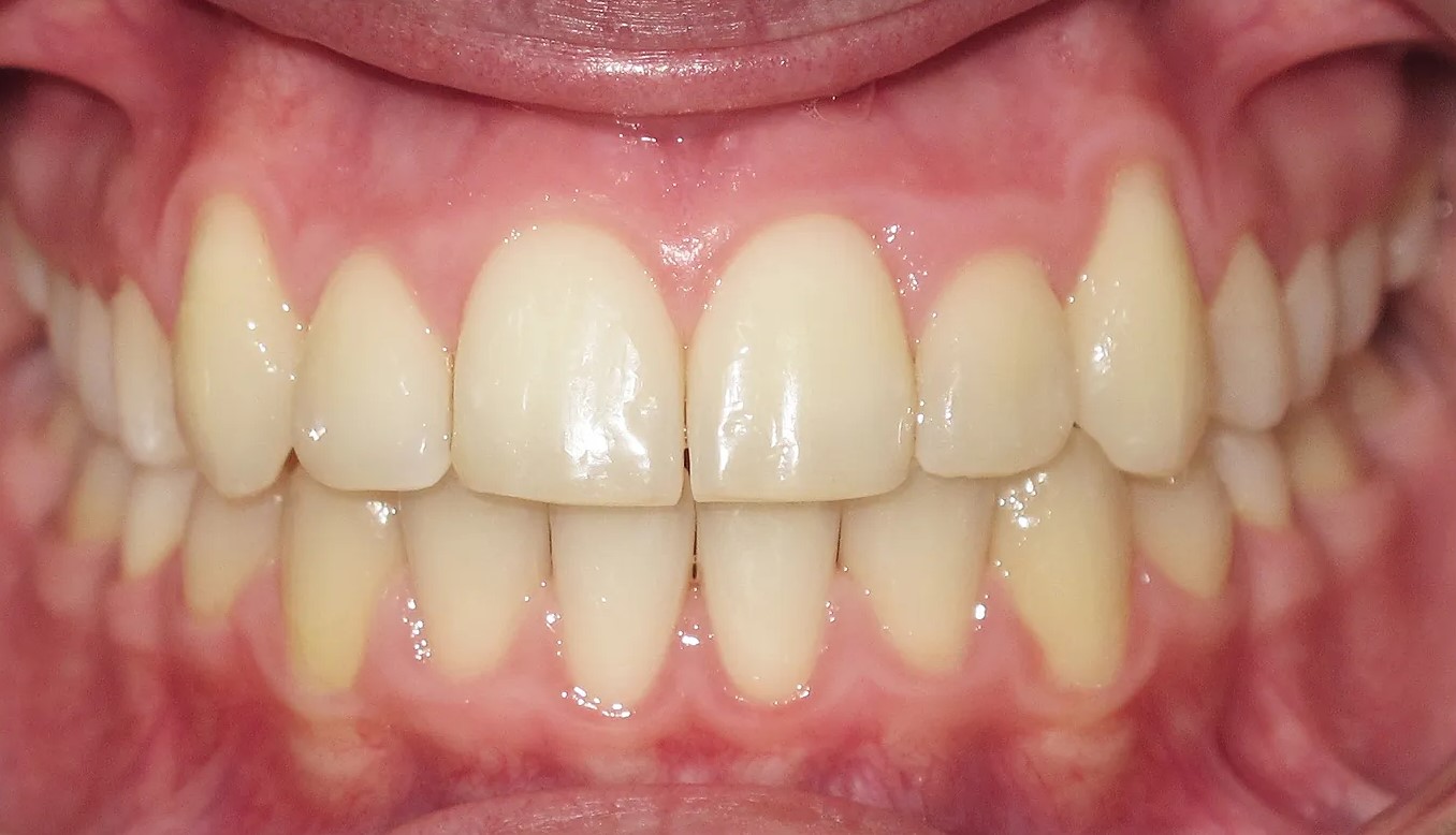 Close-up of teeth after orthodontic treatment