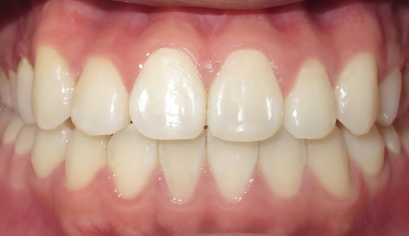 Close-up of teeth after orthodontic treatment