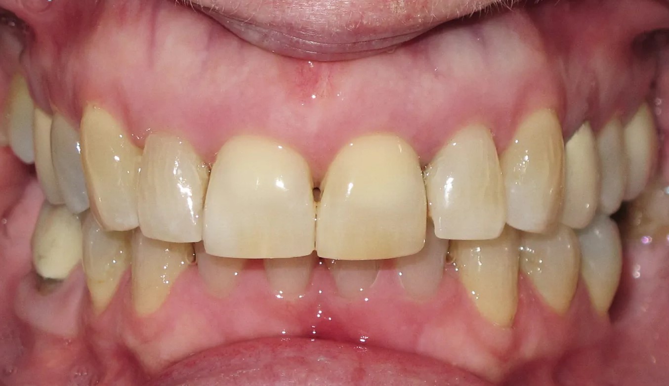 Close-up of teeth after orthodontic treatment