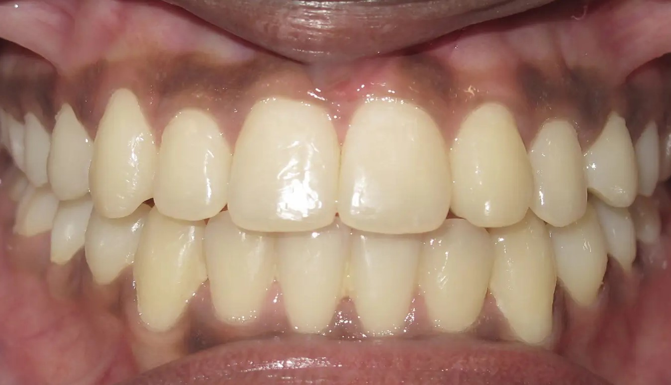 Close-up of teeth after orthodontic treatment