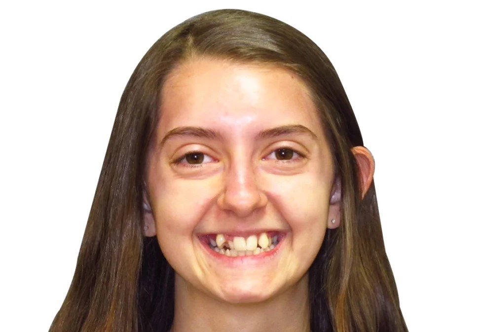 Patient smile before orthodontic treatment