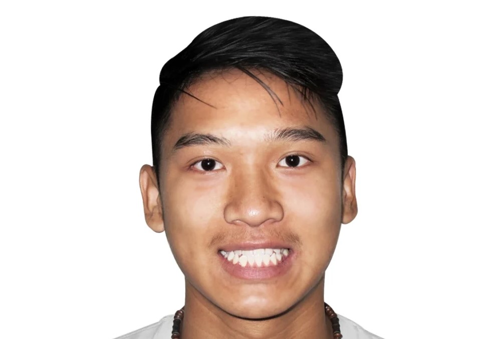 Patient smile before orthodontic treatment
