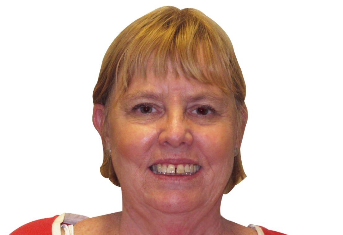 Patient smile before orthodontic treatment