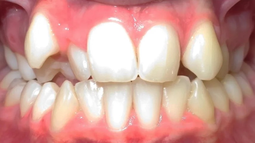 Close-up of teeth before orthodontic treatment