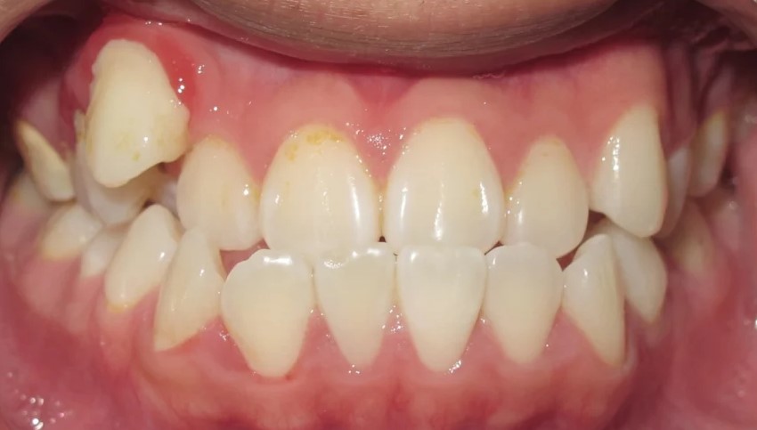 Close-up of teeth before orthodontic treatment