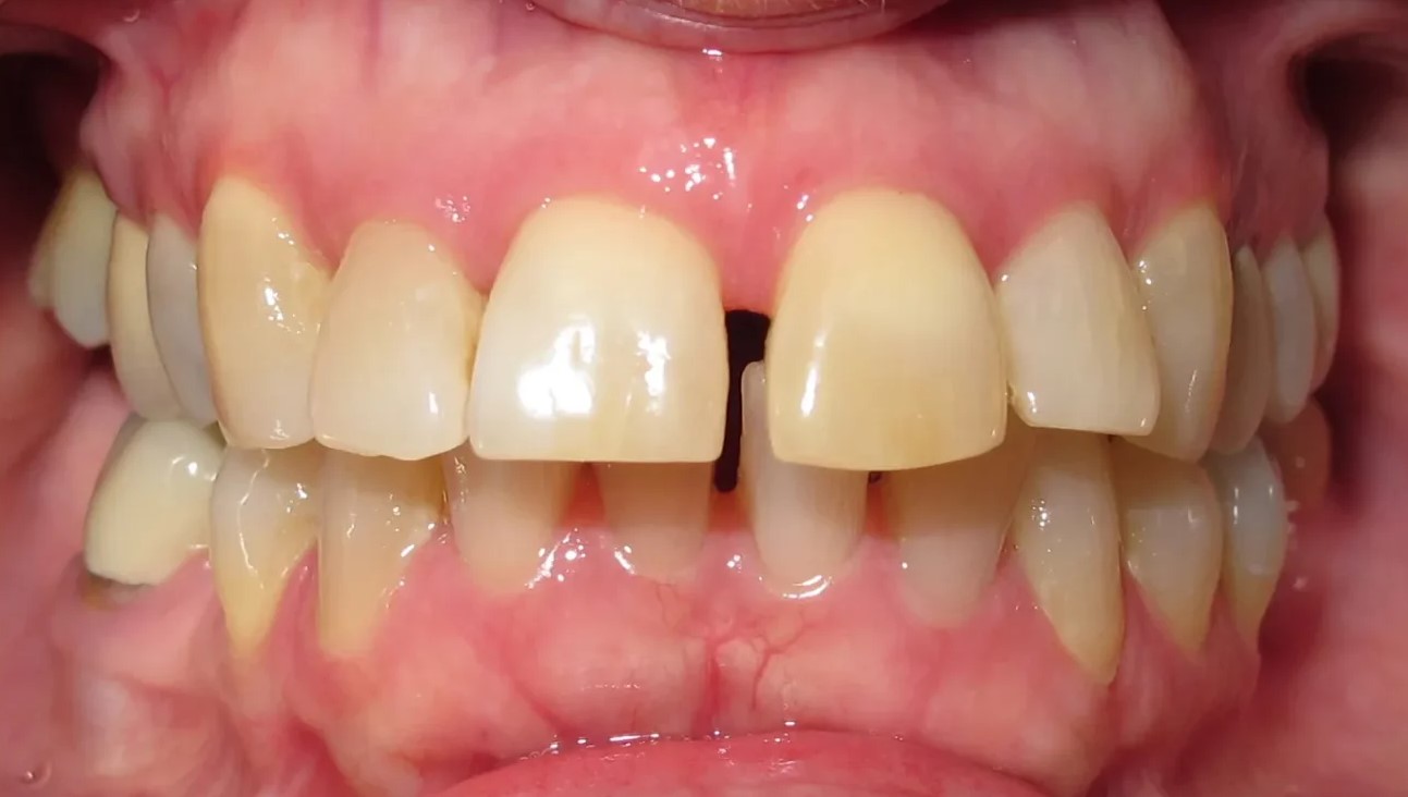 Close-up of teeth before orthodontic treatment