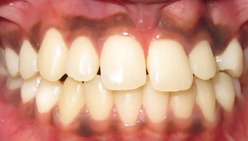 Close-up of teeth before orthodontic treatment