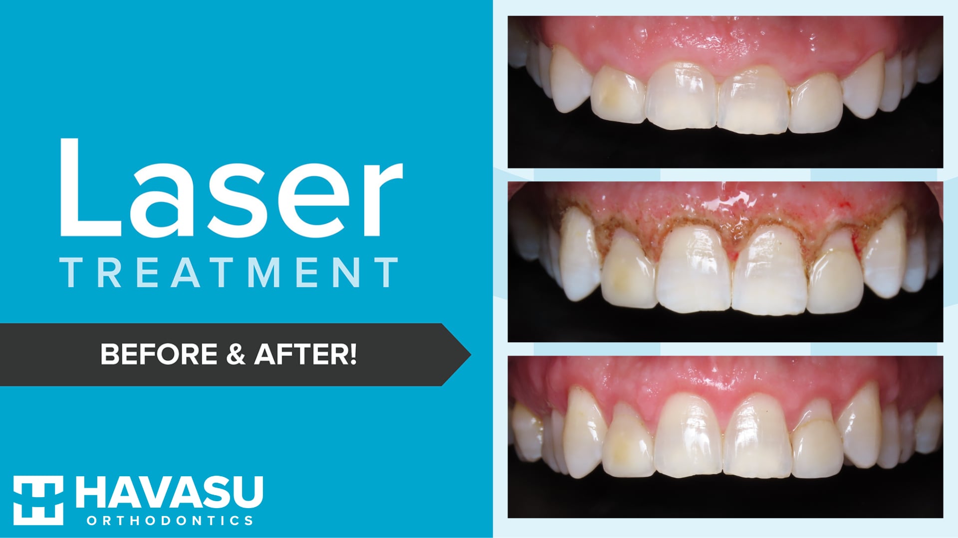 Laser gum contouring before and after comparison