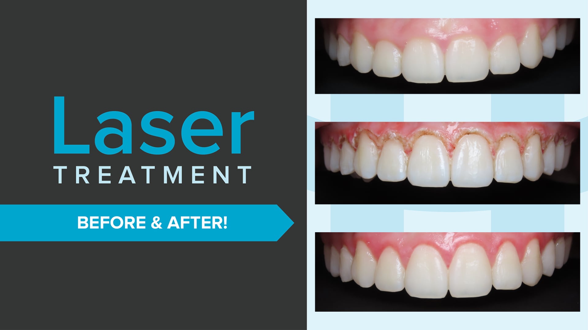 Laser gum contouring before and after comparison